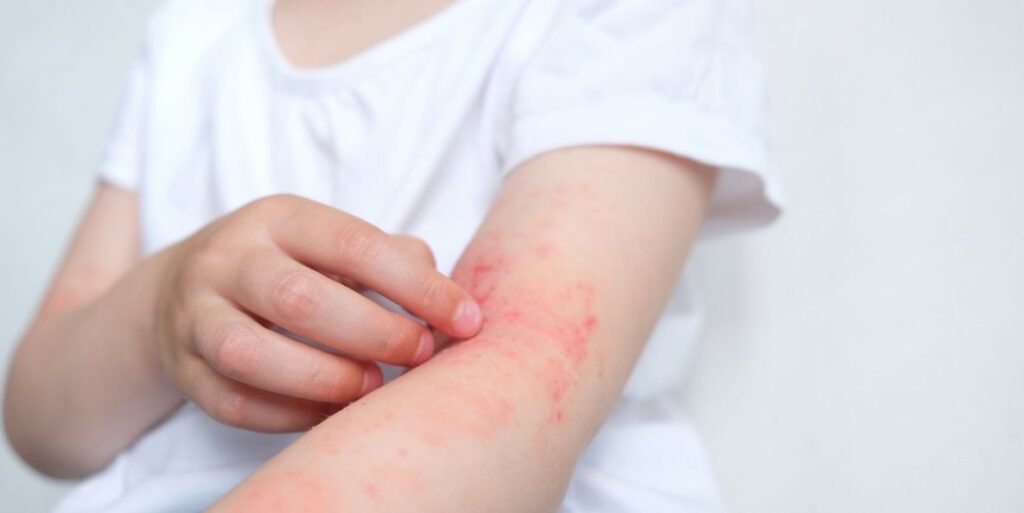Can Hereditary Allergies Be Prevented