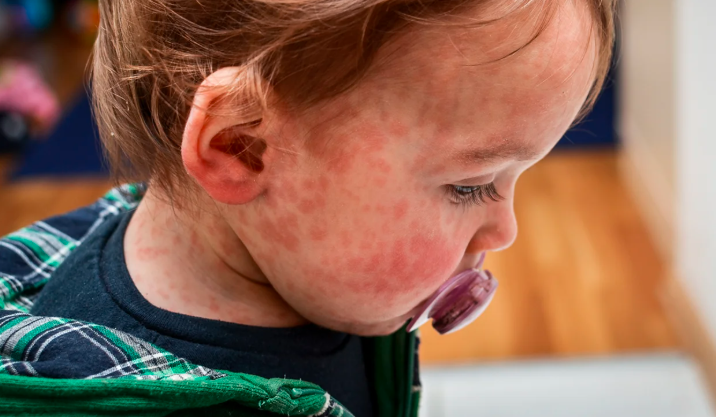 Early Allergy Signs to Watch for in Children