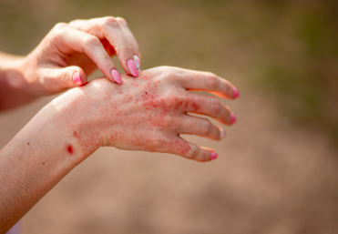 Environmental Triggers That Activate Hereditary Allergy Risk