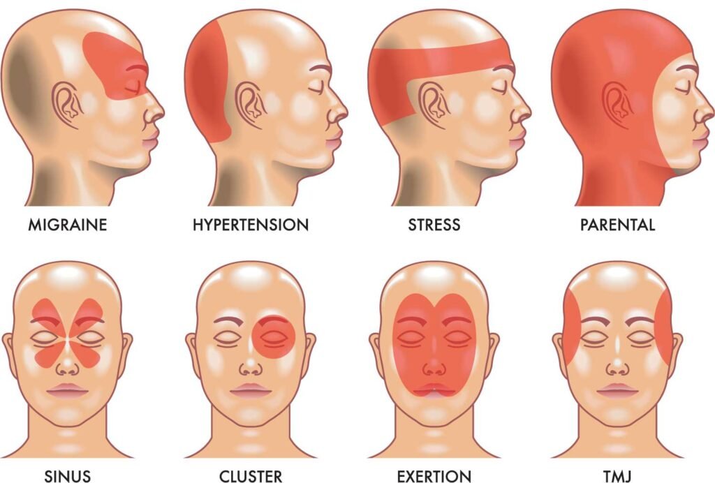 Types of Headaches