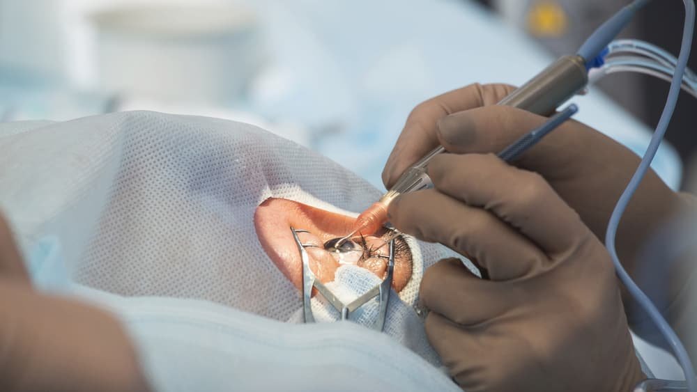 What Is Cataract Surgery