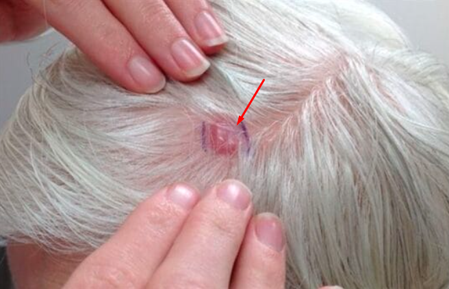 Causes of skin cancer on the scalp