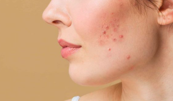 Does Dehydration Make Acne Worse