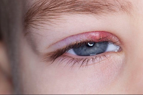 How Do Styes Spread?