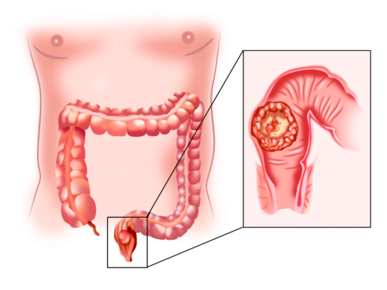Risk Factors for Colon, Rectal & Anal Cancer