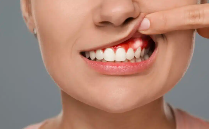 What Causes White Spots on Gums