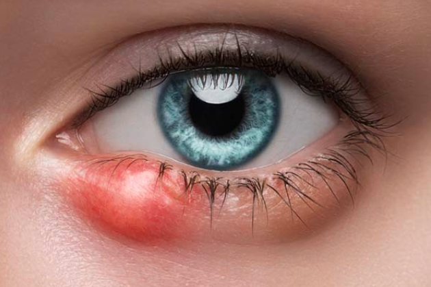 What NOT to Do With a Stye