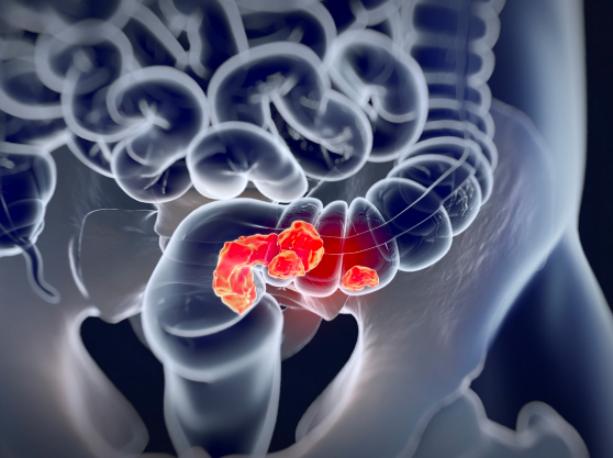 What Types of Cancer Can Cause Bowel Leakage?