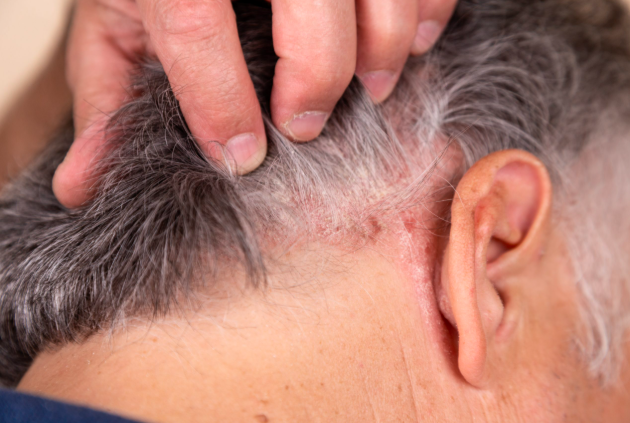 What is skin cancer on the scalp?