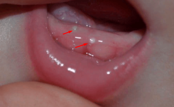 White spots on gums in babies and children